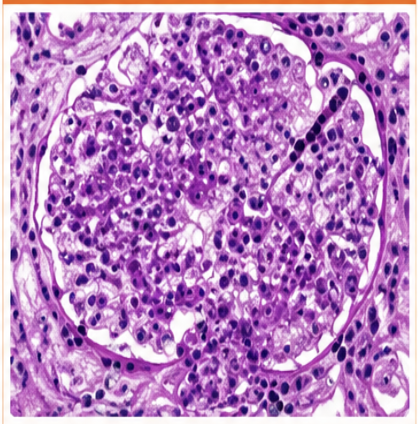 <ul><li><p>mesangiale hypercellulariteit</p></li><li><p>mesangiale matrixuitbreiding</p></li><li><p>soms segmentale sclerose </p></li><li><p>recurrente macro hematurie vaak na BLWI</p></li><li><p>oorzaak → IgA depositie in mesangium </p></li></ul><p></p>