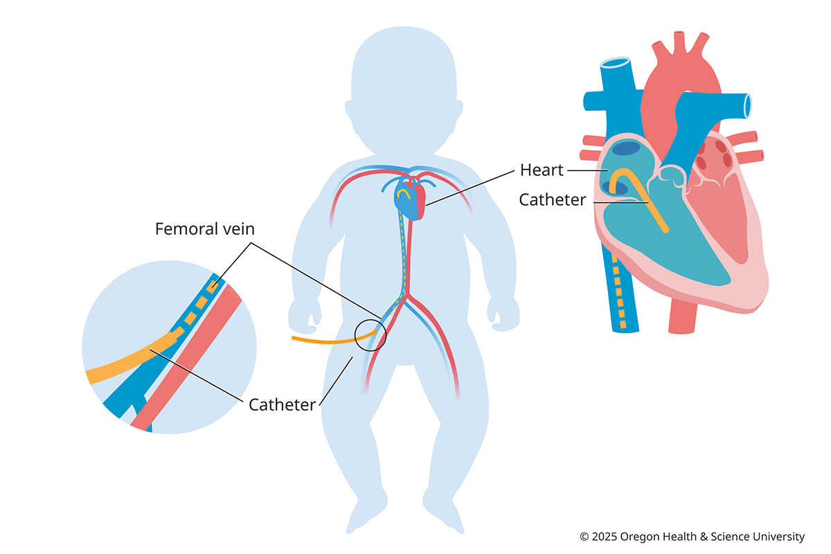 <p>an invasive procedure that guides a thin tube through a blood vessel into the heart using moving x-ray images (uses contrast)</p>