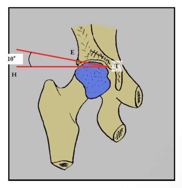 <p>FAUX : angle acétabulaire = 10°</p>