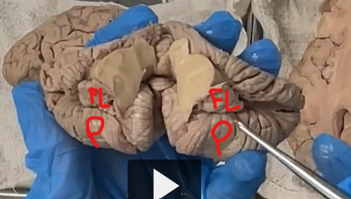 <p><strong>posterior-lateral fissures </strong>separates the <strong>Flocculus </strong>(which is a feature of the floccular-nodular lobe)<strong> </strong>from the<strong> posterior lobe</strong>. </p>