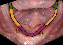 <p>The alveololingual sulcus can be divided into what three areas, as shown in the image?</p>