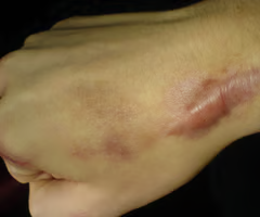 <p><span>too much collagen causes raised scarring, <strong>develop within the original boundary of a skin injury</strong></span></p>