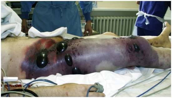 <p>Causative Agent: Clostridium perfringens<br>Symptoms/Signs: Highly fermentative; produces foul-smelling gasses; extremely serious and life threatening.</p>