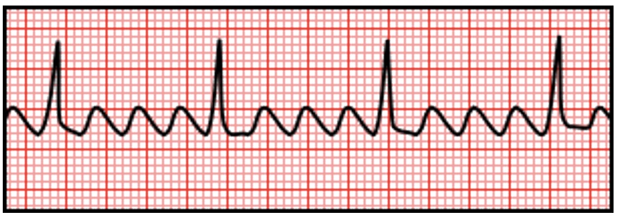 <p>Atrial flutter </p>