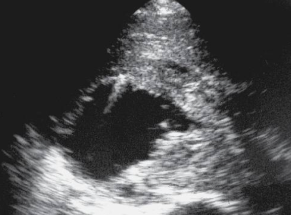 <ul><li><p>large mass is evident in renal pelvis </p></li><li><p>obstruction from kidney stones</p></li></ul><p></p>