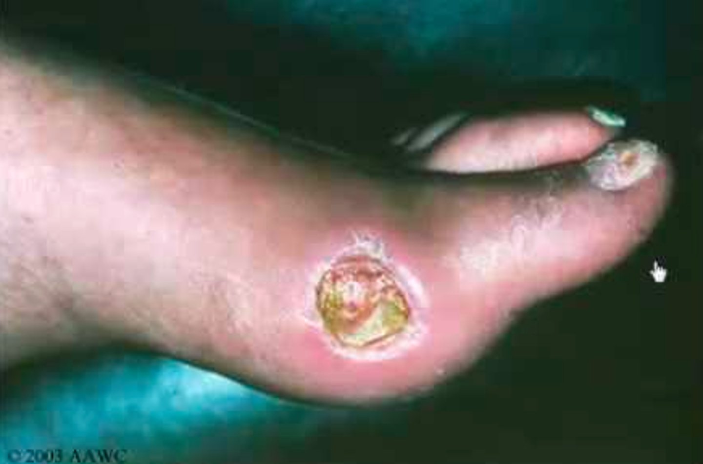 <p>- smaller than venous ulcers</p><p>- painful punched out appearance, pulseless, area distal to ulcer is cold</p><p>URGENT, schedule vascular surgery and stop smoking immediately</p>