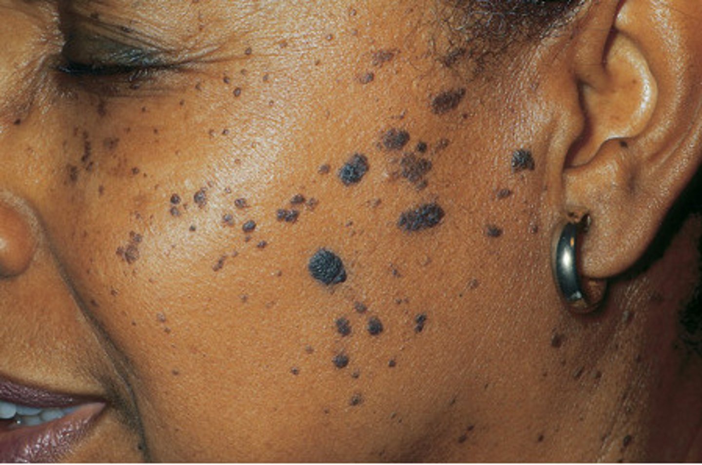 <p>greasy, velvety scaling</p><p>-non melanocytic lesion (cannot use ABCDE)</p><p>-benign</p><p>-verrucous texture (wart-like)</p><p>-appears like a "stuck on" or flattened ball of wax</p><p>-may crumble and bleed if picked</p><p>-can be darkly pigmented</p>