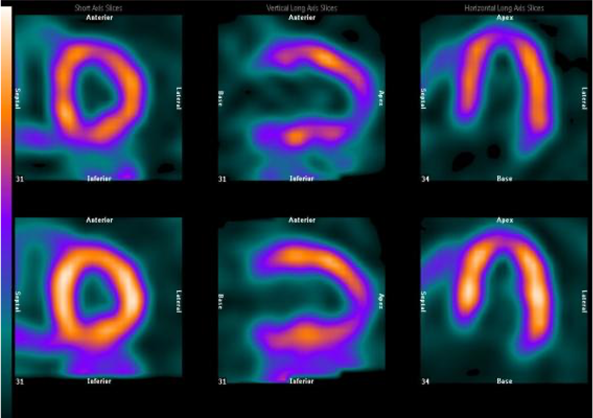<p><span>The following image shows normal functionality/metabolic activity of the heart</span></p>