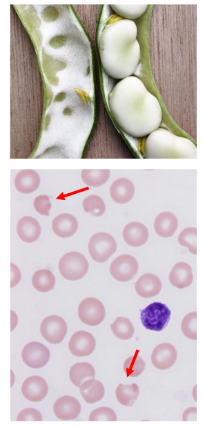 <p>G6PD Deficiency</p>