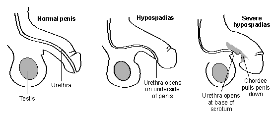 <p><span>Incomplete or improper fusion of the urogenital (urethral) folds during foetal development</span></p>