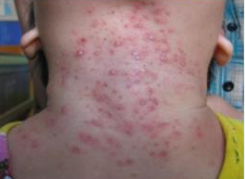 <p>Infección estafilocócica aguda de los conductos y glándulas sudoríparas ecrinas del lactante.</p>