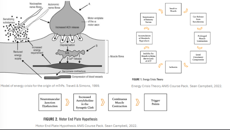 <ul><li><p>Discrete and hypersensitive nodule within tight band of muscle or fascia</p></li><li><p>Result of acute trauma or microtrauma</p></li><li><p>Hypothesized that build up of ACh at neuromuscular junction or lack of ATP leads to the formation of taut band</p></li><li><p>Can be treated with manual soft tissue techniques, foam rolling, dry needling</p></li><li><p>Classified as latent or active</p><ul><li><p>Latent = does not cause spontaneous pain but may restrict movement or cause muscle weakness → aware once pressure is applied</p></li><li><p>Active = causes pain at rest, elicits “jump sign” when pressure is applied, causes a referred pain pattern similar to the patient’s pain complaint</p></li></ul></li></ul><p></p><ul><li><p>Ischemia - Lack of blood flow</p></li></ul><p></p>