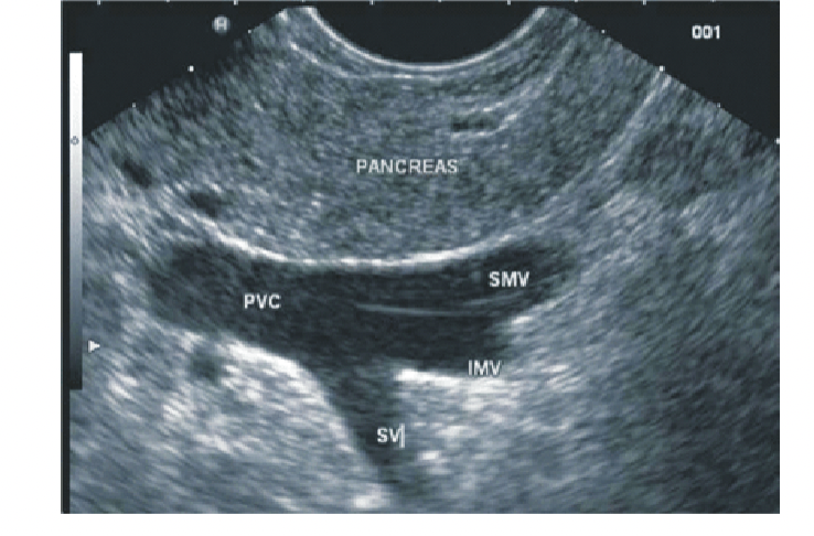 <p>What is the portosplenic confluence</p>
