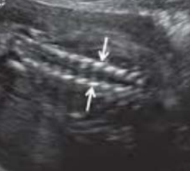 <p>What are the arrows pointing to in this image?</p><p>a. Vertebral body ossification</p><p>b. Lateral ossification centers</p><p>c. Fetal cranium</p><p>d. Myelomeningocele</p>