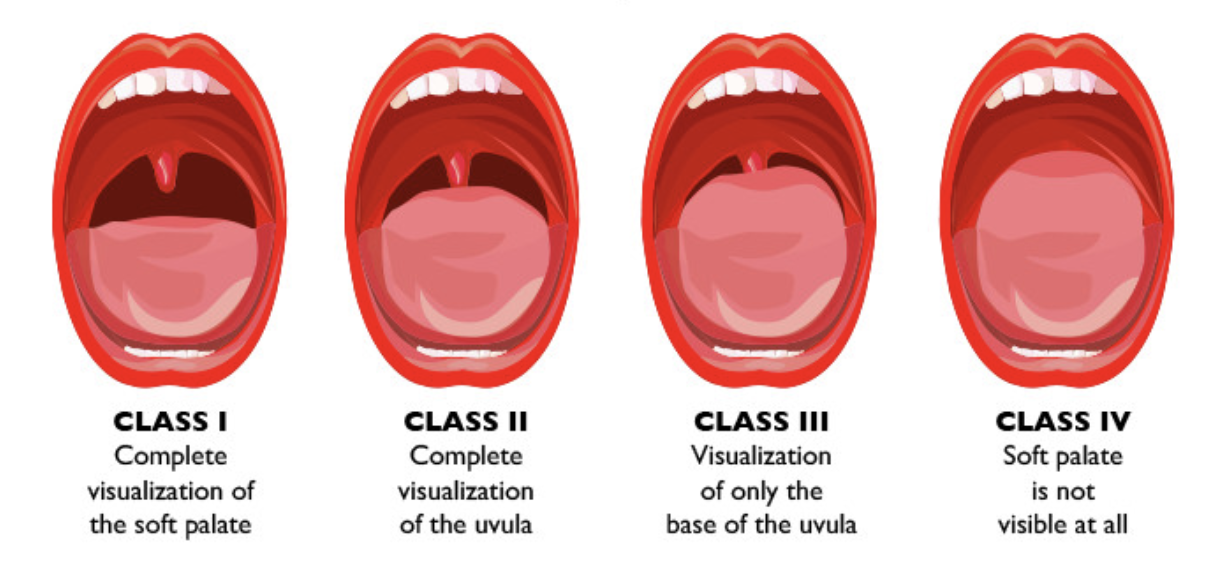 <p>predict intubation difficulty or predict sleep apnea </p><ul><li><p>what structures in throat are visible when pt opens mouth </p></li><li><p>think “more mouth = more easy”</p></li><li><p>classes 3 and 4 = difficult intubation or probability of sleep apnea </p></li></ul><p></p>