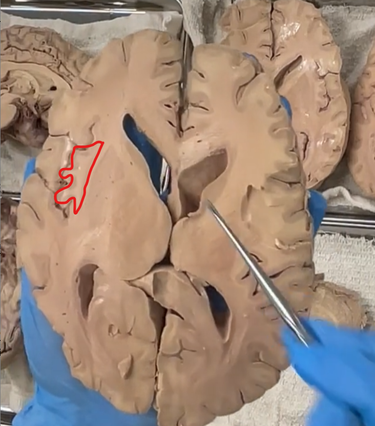 <p>lateral to the external capsule is the collustrum.</p><p>the insular cortex is the outer of the collustrum. </p>