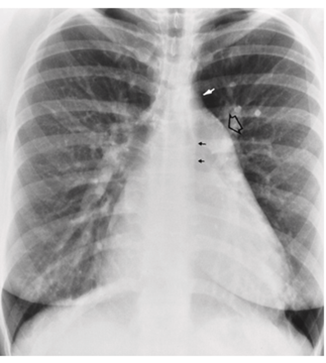 <p>A. CHD atrial septal defect</p>