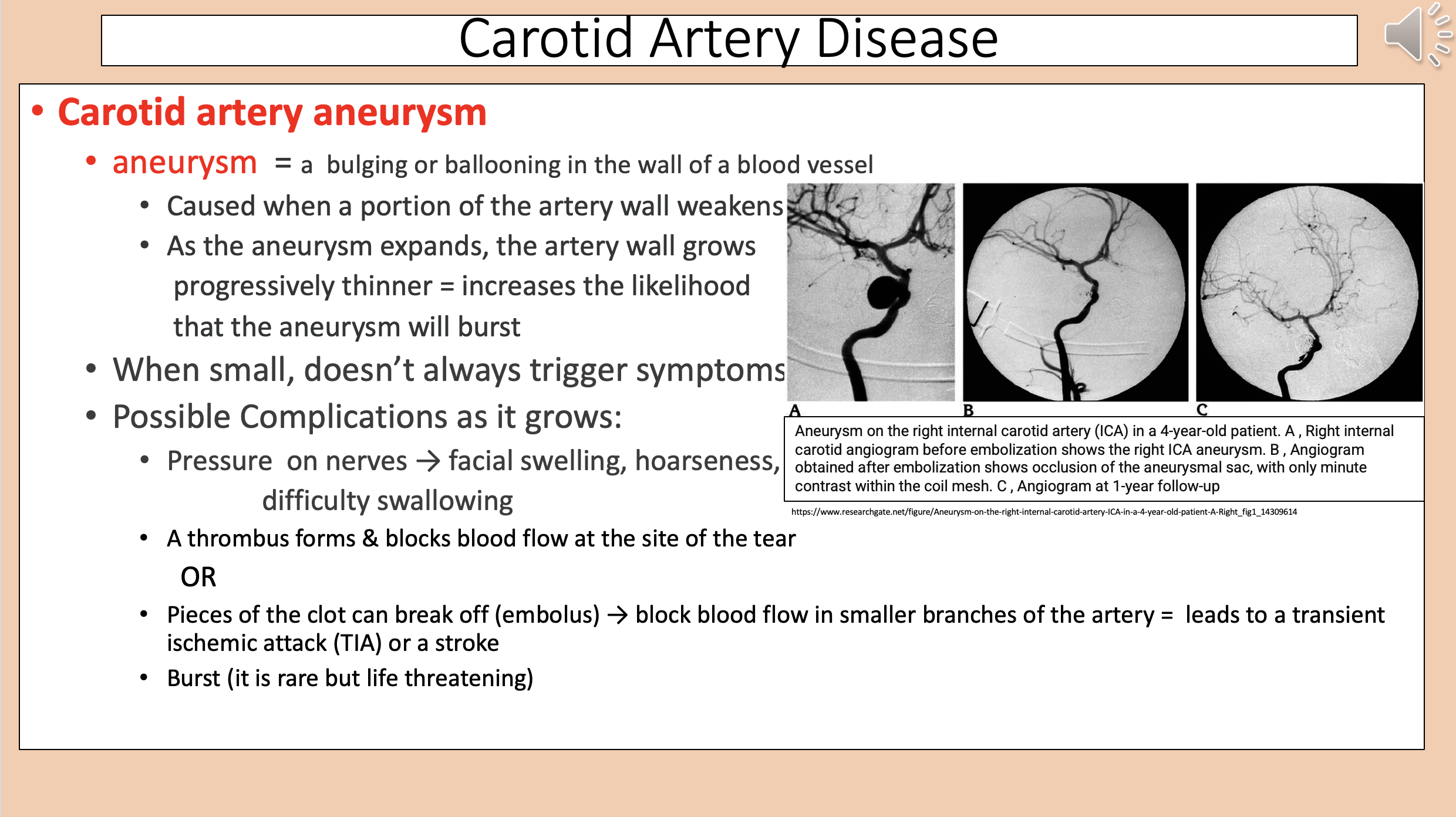 <p><span style="color: rgb(255, 0, 0);">carotid artery aneurysm</span></p>