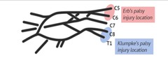 <p>A type of paralysis that affects the arm and is caused by injury to the upper group of arm nerves.</p>