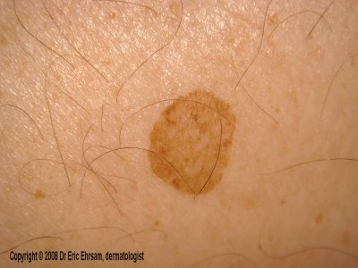 <p>flat, colored spot on the skin</p>