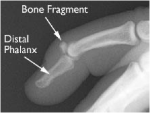 <p>What fracture is shown in the image?</p>