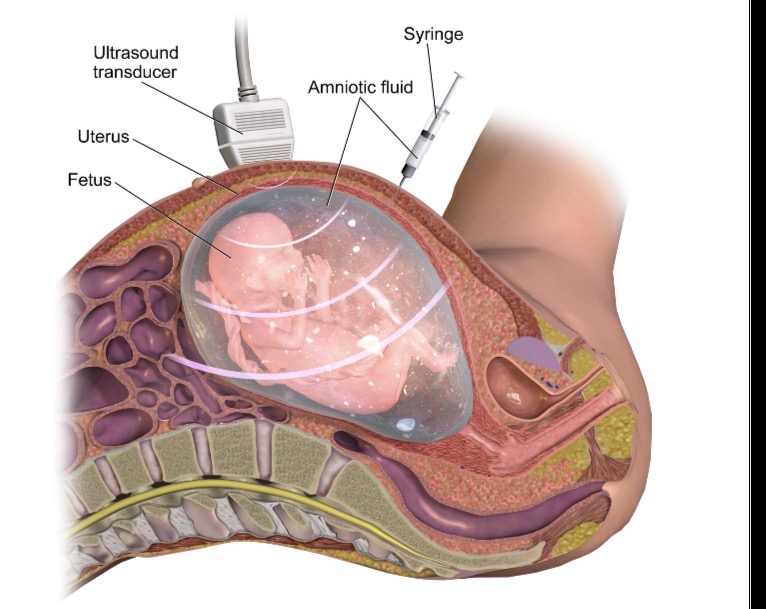 <p>Amniocentezė – tikslas</p>