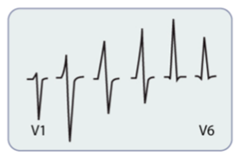 <p>R-wave amplitude increases from V1 to V5</p>