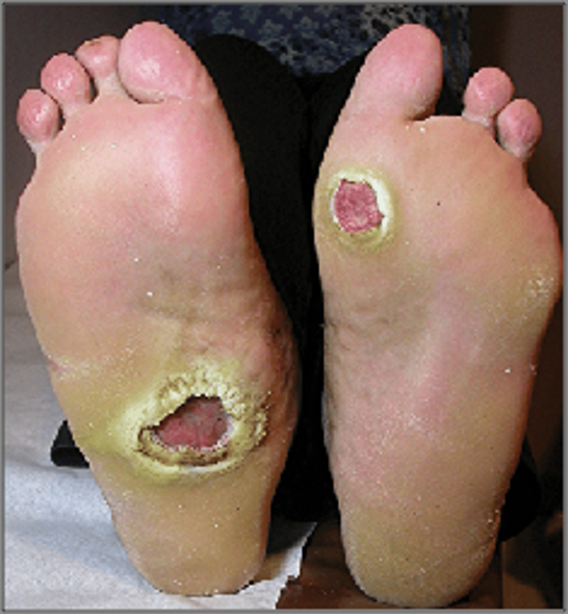 <p>deep punched out lesions on lower extremities</p><p>PAINLESS</p>