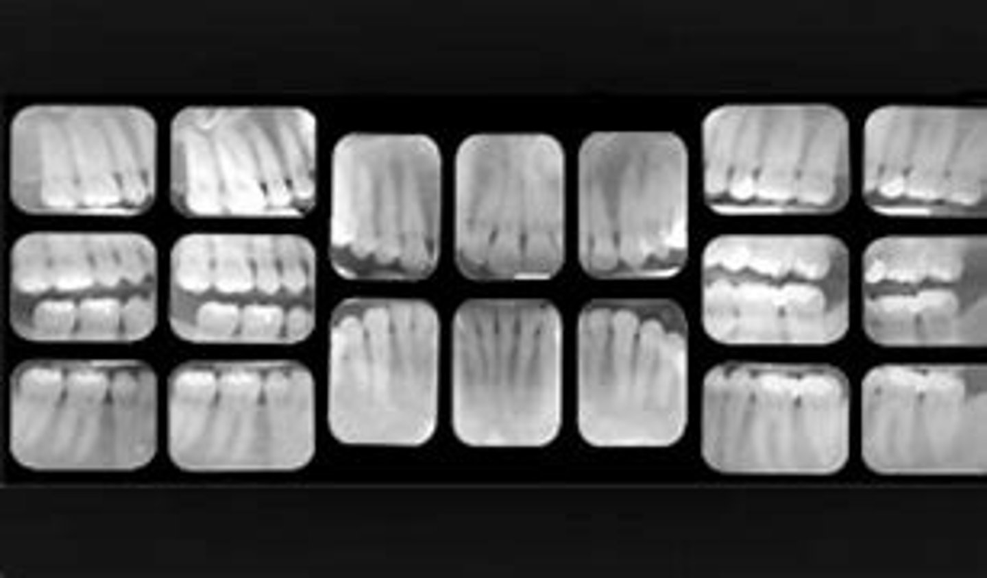 <p>best up close overall look at the mouth</p><p>typically consists of 18 images</p><p>*8 posterior-4 on each side</p><p>*6 anterior</p><p>includes 4 BW</p>