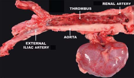 <p>Saddle thrombus</p>
