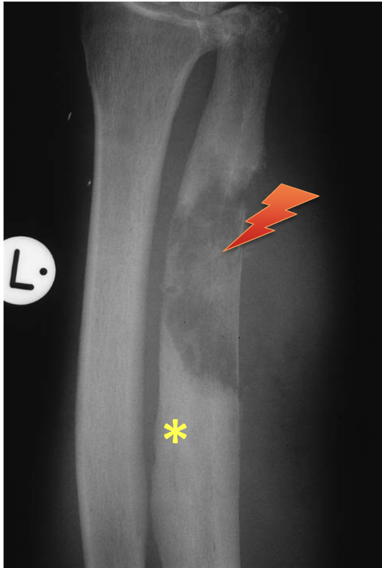<p>What tumour like disorder is this?</p>