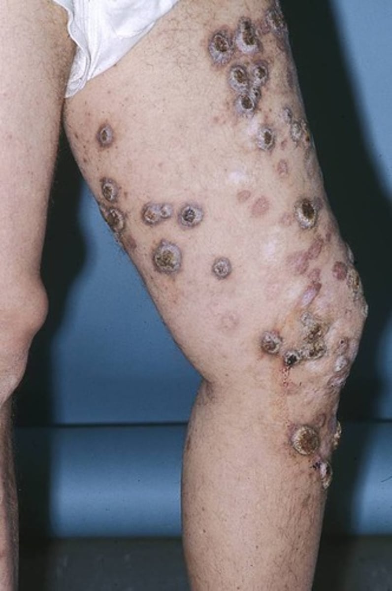 <p>- Coccidioidomycosis (flu-like, repiratory)</p><p>- Disseminated (CNS, skin, musculoskeletal)</p><p>- African American, Filipino and Latino descent more at risk</p>
