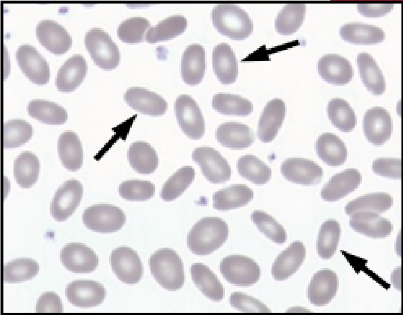 <p><strong>Smear Findings</strong></p><ul><li><p>few to many ovalocytes</p></li></ul><p><strong>MCV</strong>: 82-98</p>