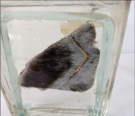 <p>Questions</p><ol><li><p>What is the specimen being examined?</p></li><li><p>What are the descriptive features of the injury on the scalp?</p></li><li><p>What is the likely causative instrument for this type of injury?</p></li><li><p>How is the time of death estimated in relation to the injury?</p></li><li><p>What are the possible causes of death?</p></li><li><p>What is the final diagnosis for this specimen?</p></li></ol><div data-type="horizontalRule"><hr></div><p></p>