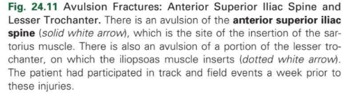 <p>Avulsion fracture</p>