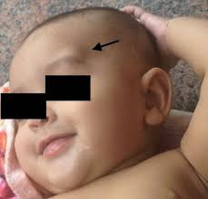 <p>dermoid cyst</p>