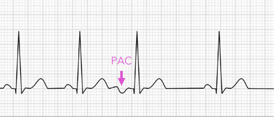 <p>Occurs when atrial tissue other than the sinus node spontaneously depolarizes earlier than the sinus node and produces this premature contraction</p><p></p>