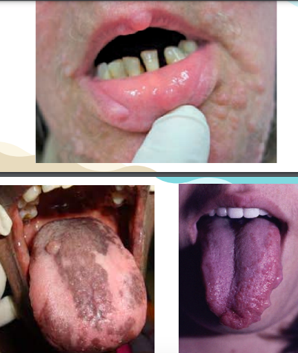 <p><span style="color: red;">overgrowth </span>of the alveolar ridge</p><p><span style="color: red;">severe periodontitis &amp; calcular deposits</span></p><p>presence of impacted displaced or <span style="color: red;">missing teeth in the mandible</span></p><p><span style="color: red;">hemifacial disfigurement </span>→ caused by <span style="color: red;">plexiform neurofibroma</span> of the trigeminal nerve</p>