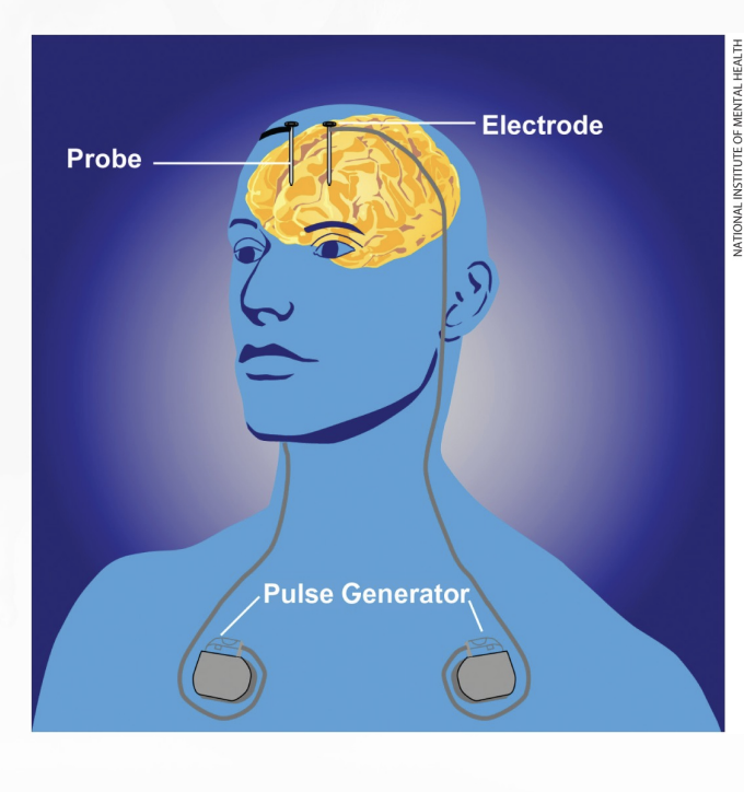 <p>insertion of battery-powered electrodes that deliver electrical pulses to specific brain areas believed to be causing a person’s mental disorder</p>