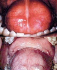 <ol start="89"><li><p>Identify the finding shown.</p></li></ol><p></p>