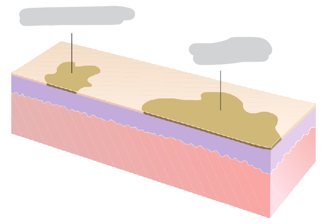 <p>Macule vs Patch</p>