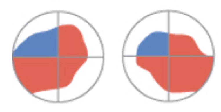 <p>quadrantanopia </p>