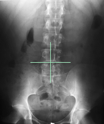 <p>AP L-Spine: Is this Image Good?</p>