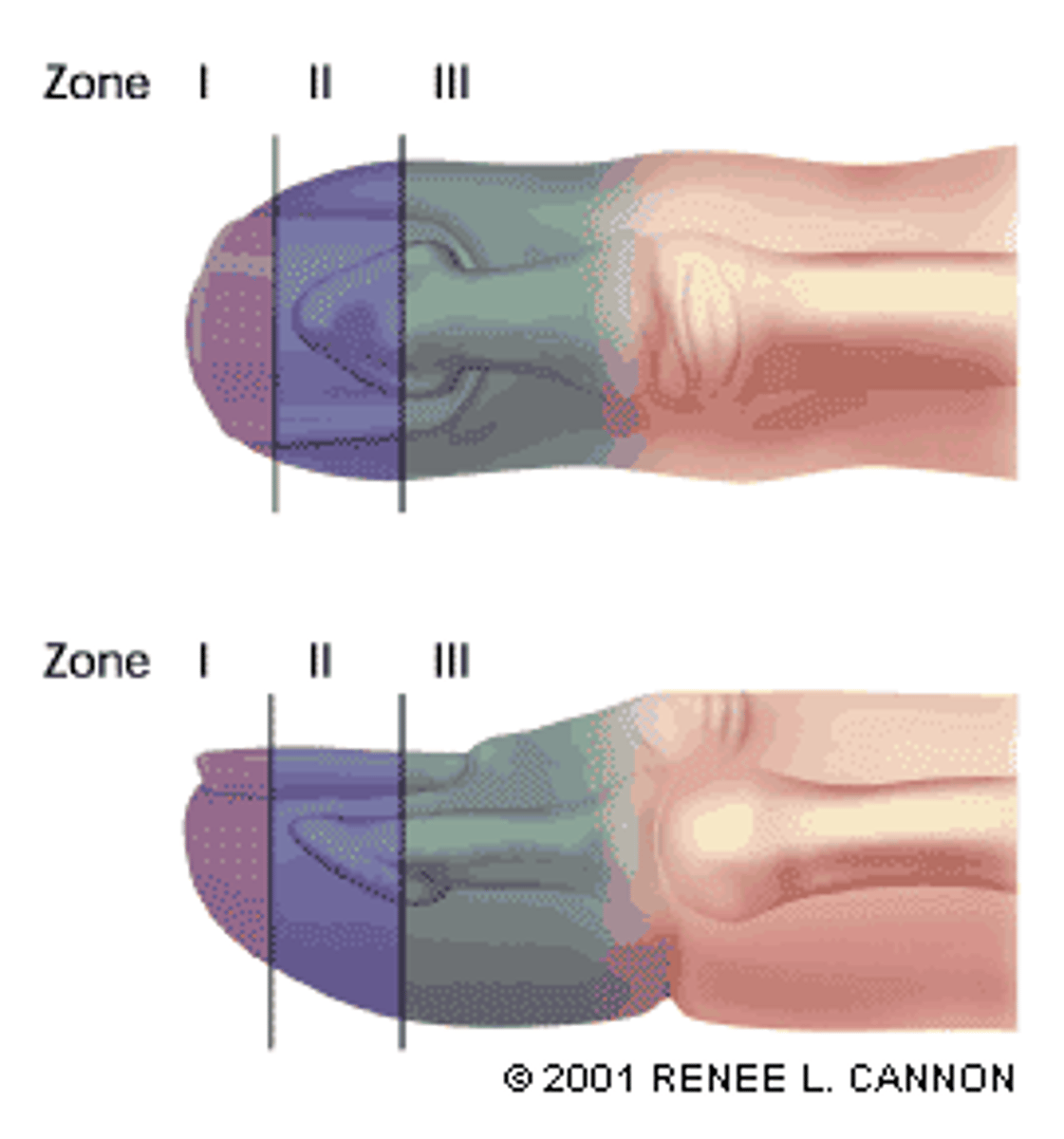 <p>Nail Injury</p><p>Zone 1 - distal to bony phalanx</p><p>Zone 2 - distal to lunula</p><p>Tx: V-Y advancement</p><p>Zone 3 - proximal to distal end of lunula</p><p>If nail bed is lacerated, it is considered an open fracture</p><p>Tx: amputation</p>