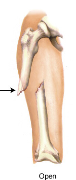 <p>broken bone protrudes through the skin</p>