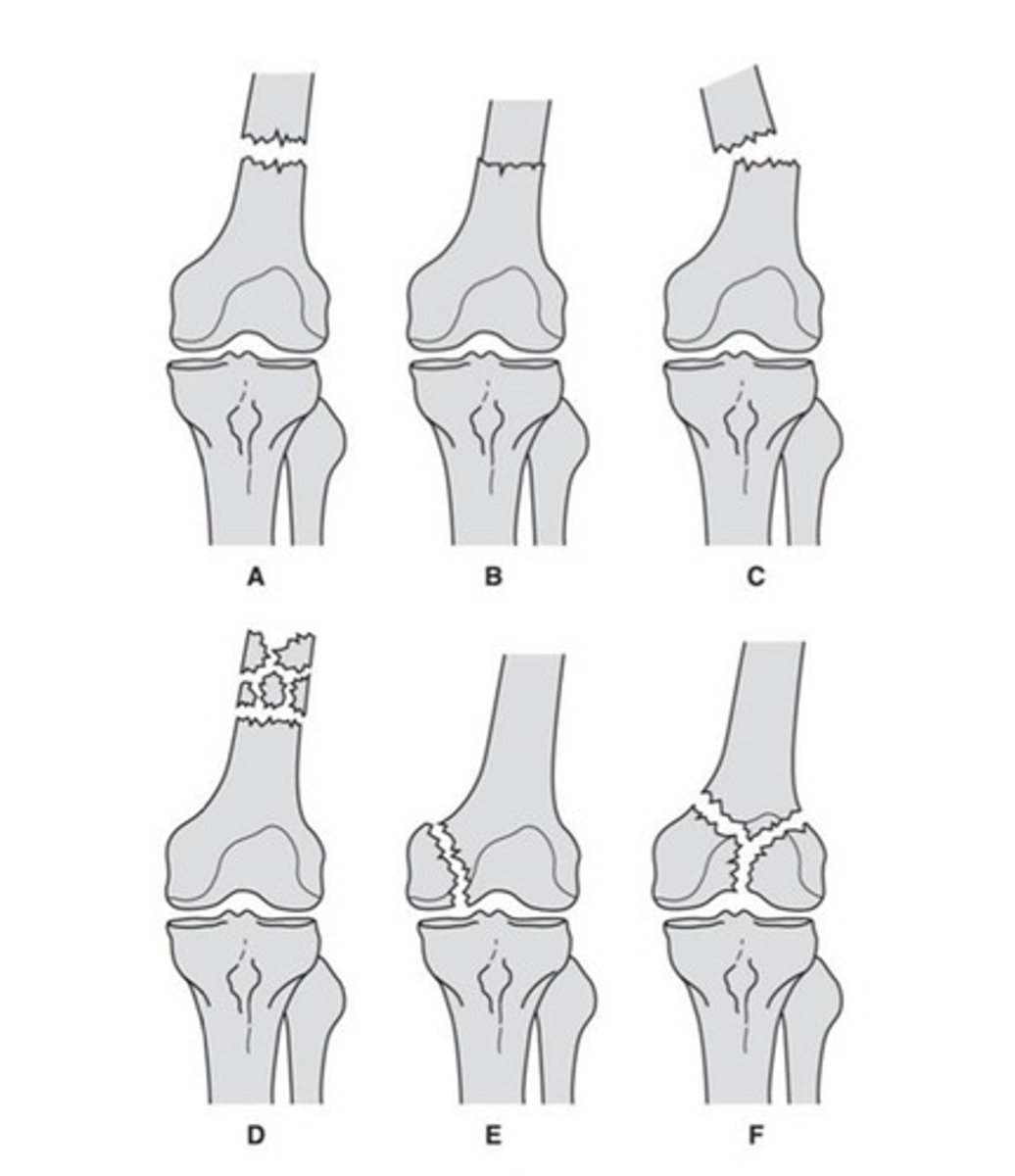 <p>What type of fracture does D show?</p>