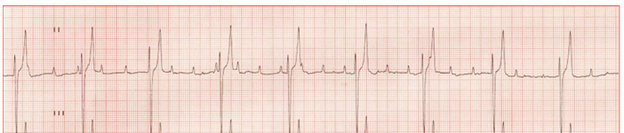 <p>What does this ECG show?</p>