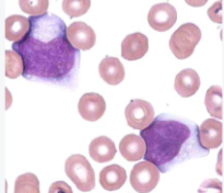 <p>What are the large cells called? What nickname is given to them? What disease and pathogen is most associated with these cells?</p>