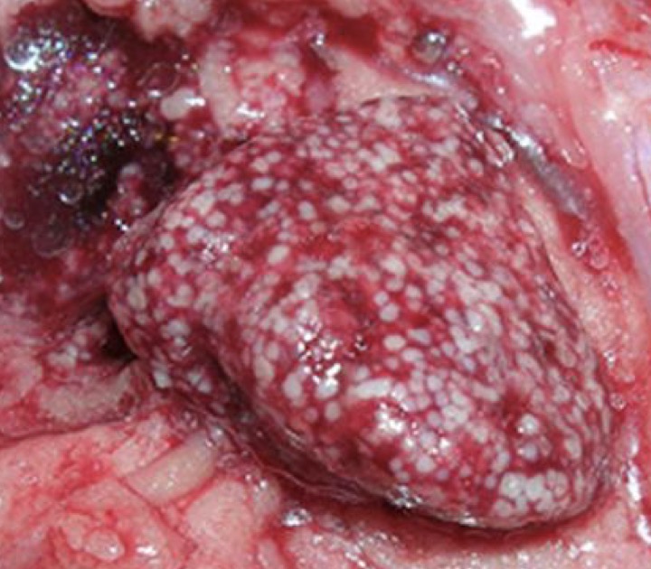 <p>What bacteria is responsible for the following lesion?</p>