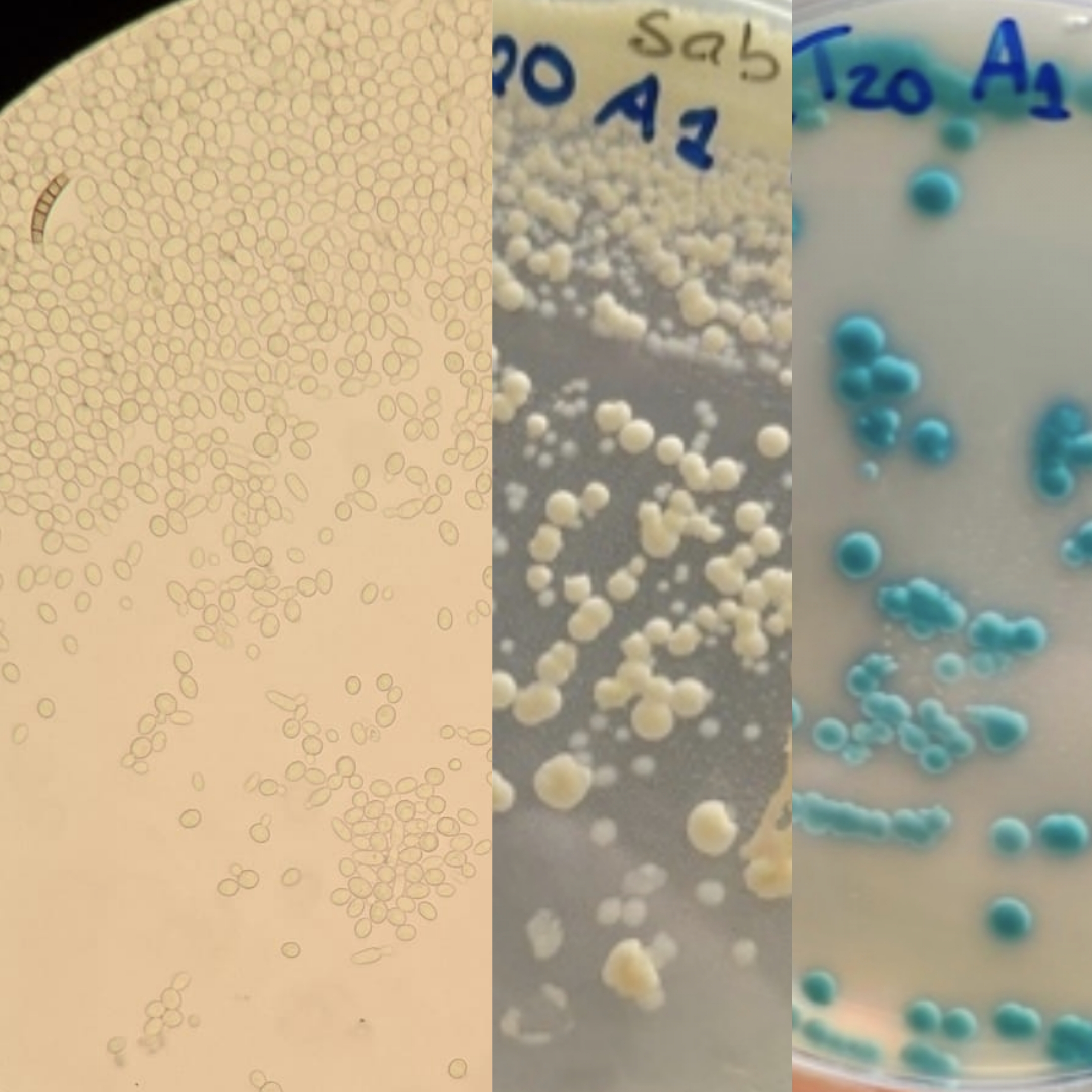 <p>Identifica a levedura pelos resultados nas provas de identificação:</p><p class="has-focus">Prova dos clamidosporos: +</p><p class="has-focus">Prova da filamentaçao: +</p><p class="has-focus">Prova dos ascosporos: -</p><p class="has-focus">Prova da urease: -</p><p class="has-focus">Prova da fenoloxidase: -</p><p class="has-focus">Sensibilidade à cicloheximida: + ( não é sensível é resistente, cresce)</p><p class="has-focus">Cor no meio de chromagar Cândida: azul esverdeado</p>